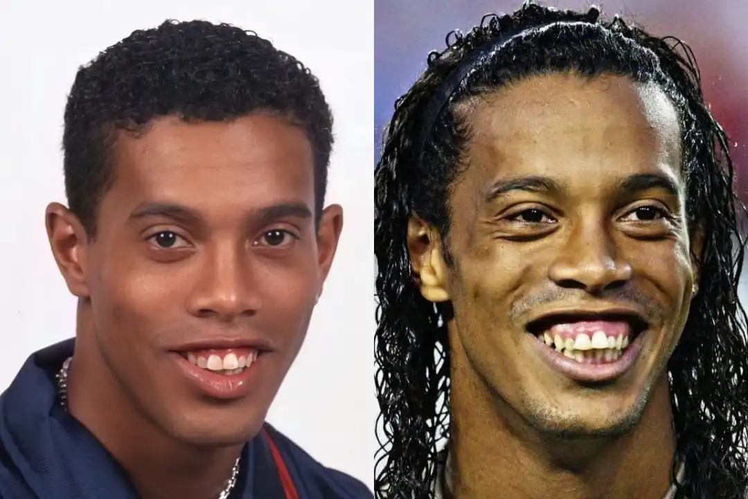 Ronaldinho's teeth in his youth