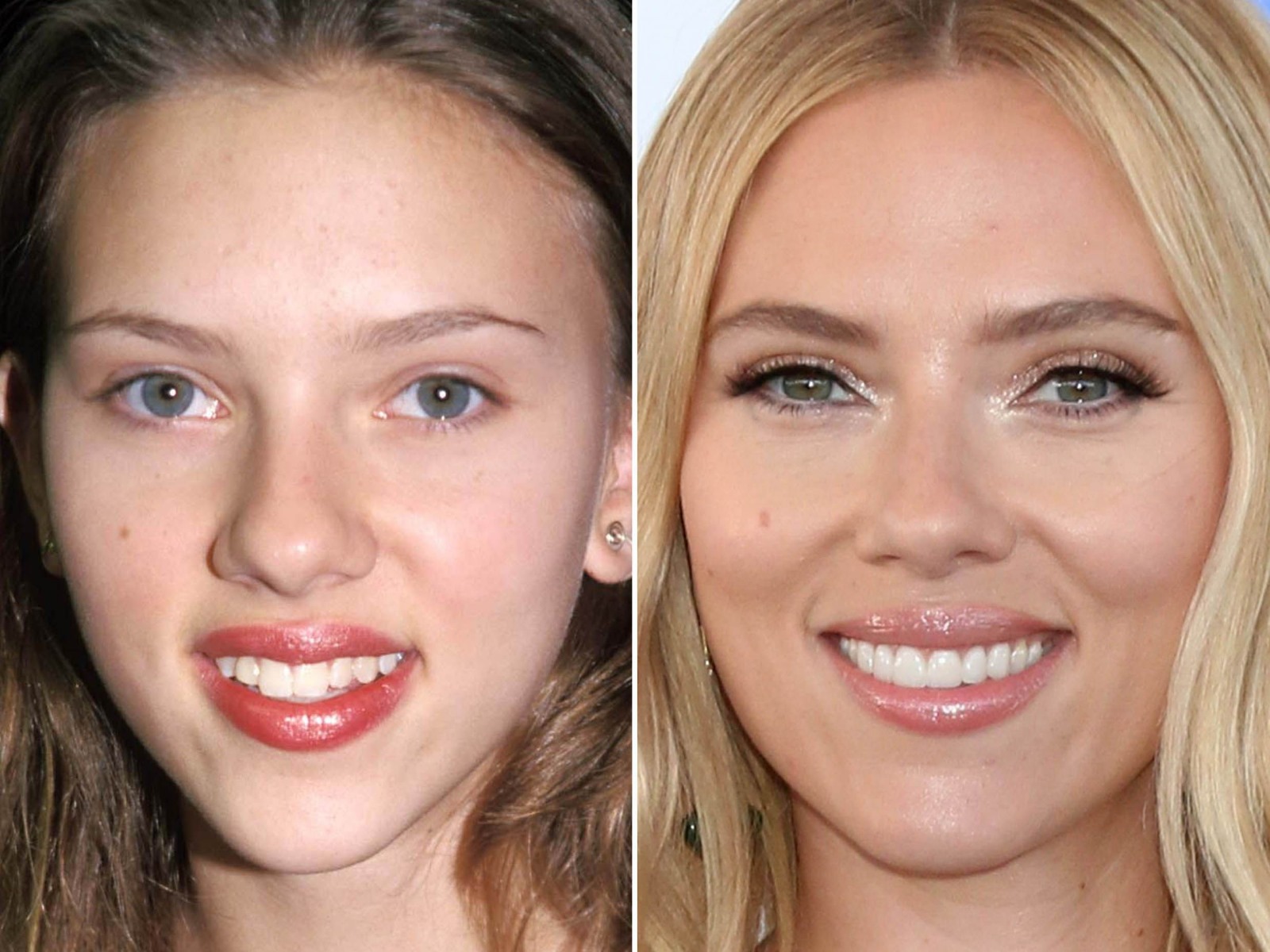 Celebrity veneers before and after Antalya, Turkey