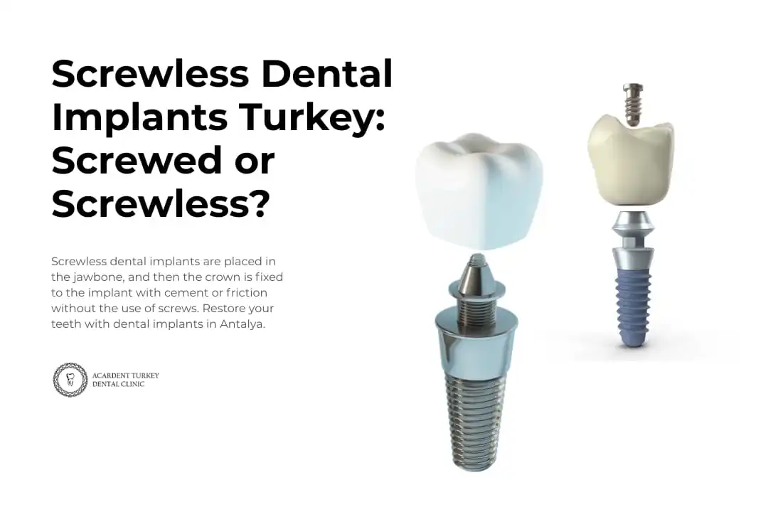 Screwless Dental Implants Turkey: Screwed or Screwless?