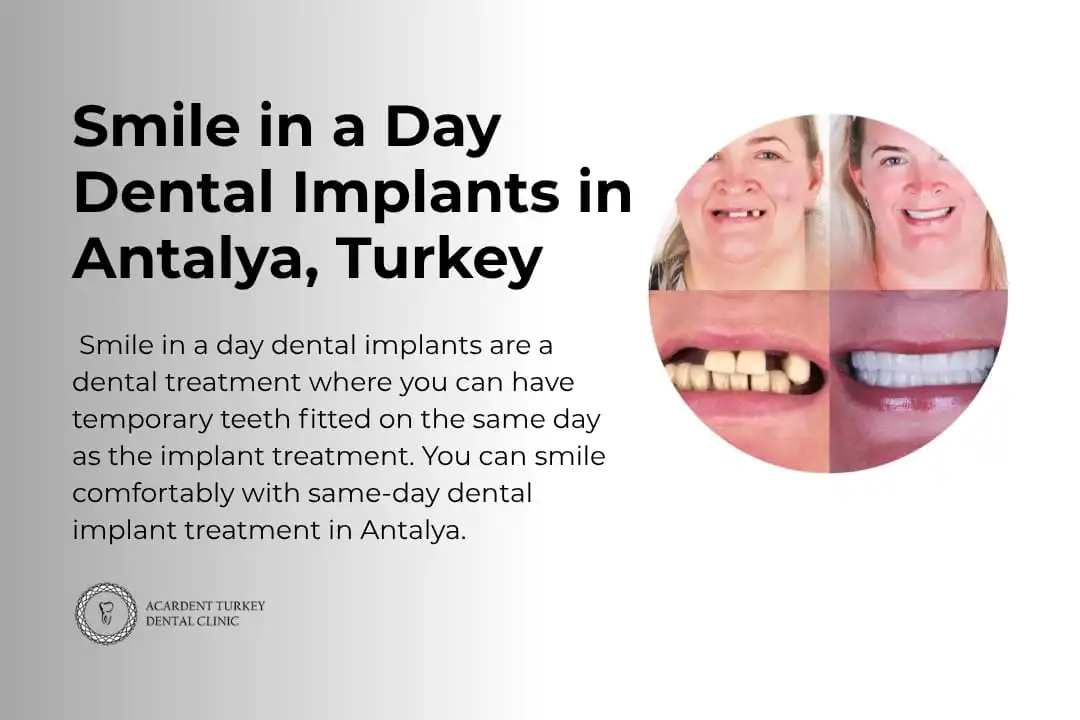 Smile in a Day Dental Implants in Antalya | Acardent Turkey Clinic