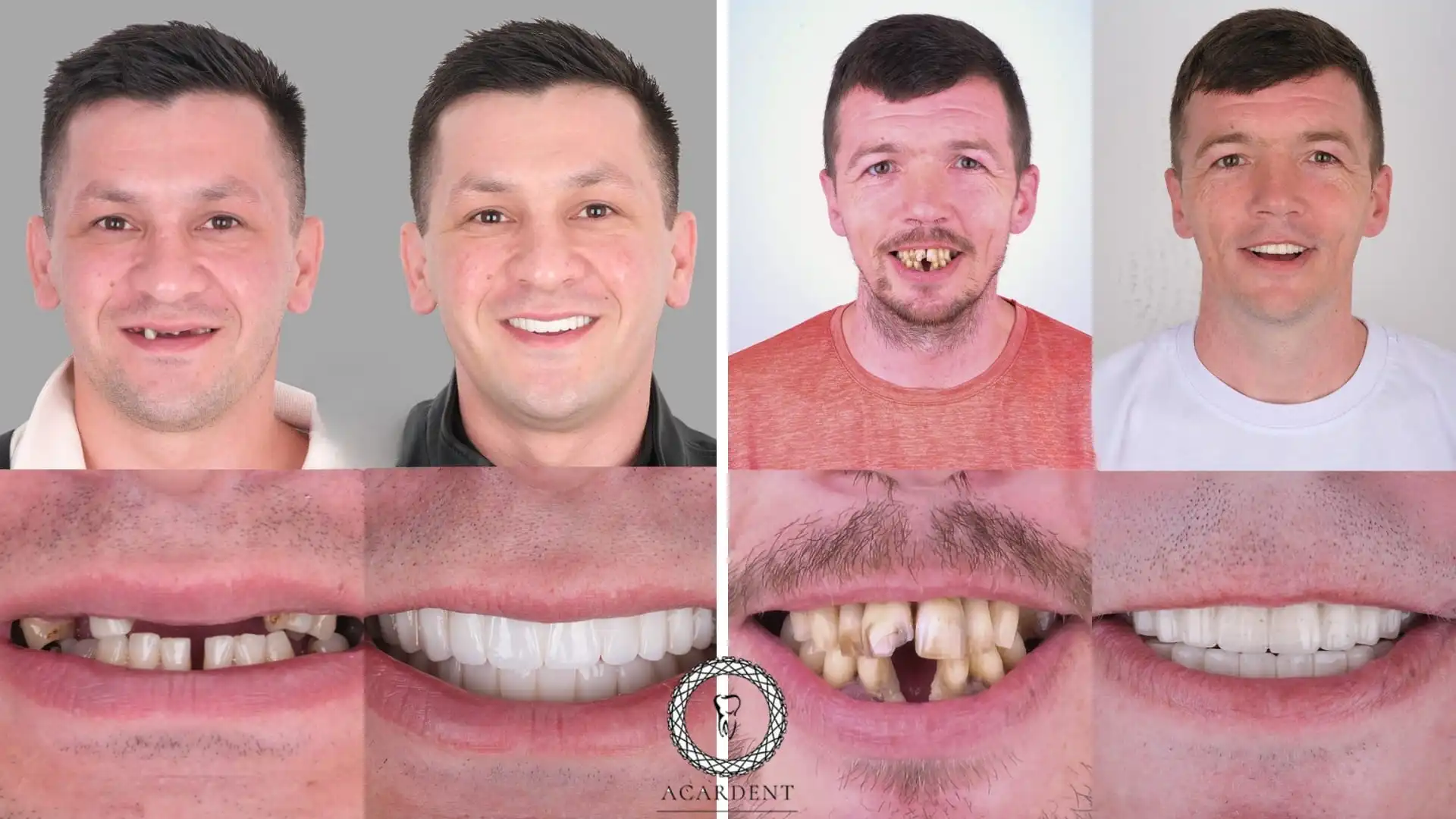 What are smile in a day dental implants in Antalya, Turkey?
