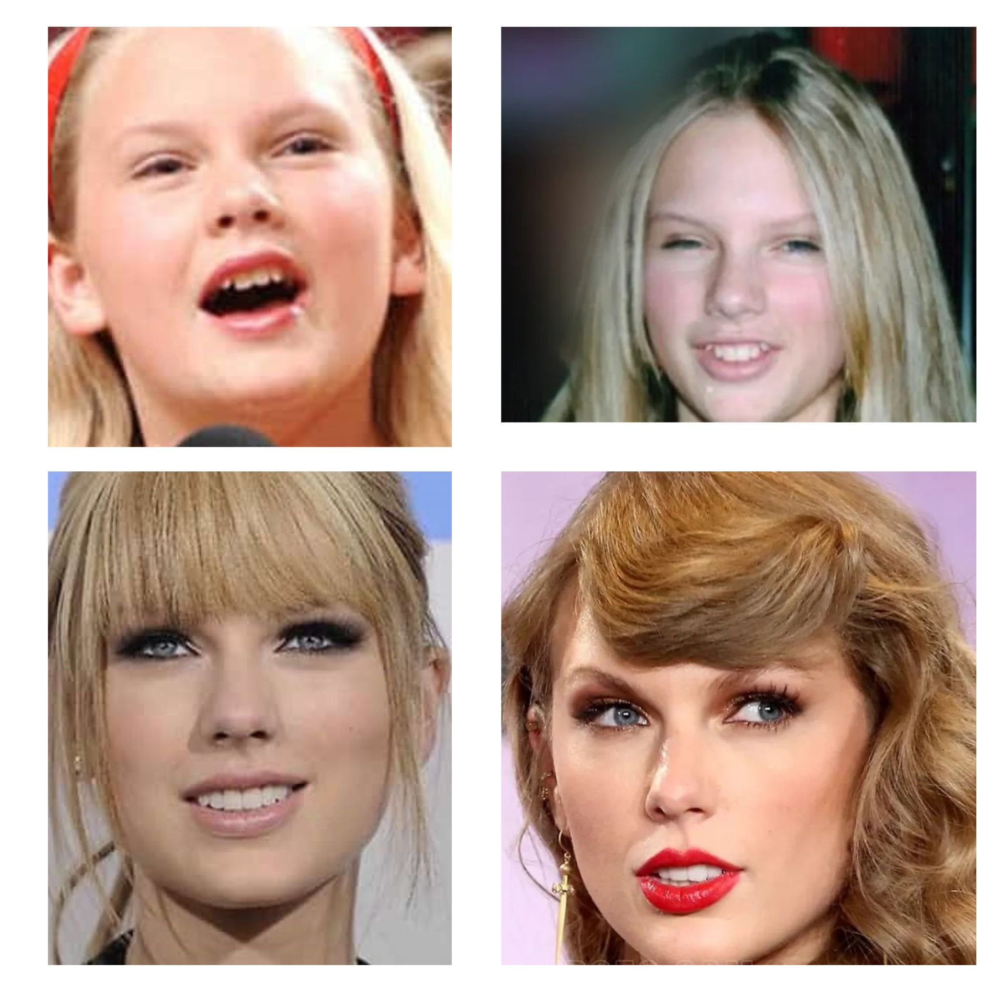 Taylor Swift Teeth Before After Turkey