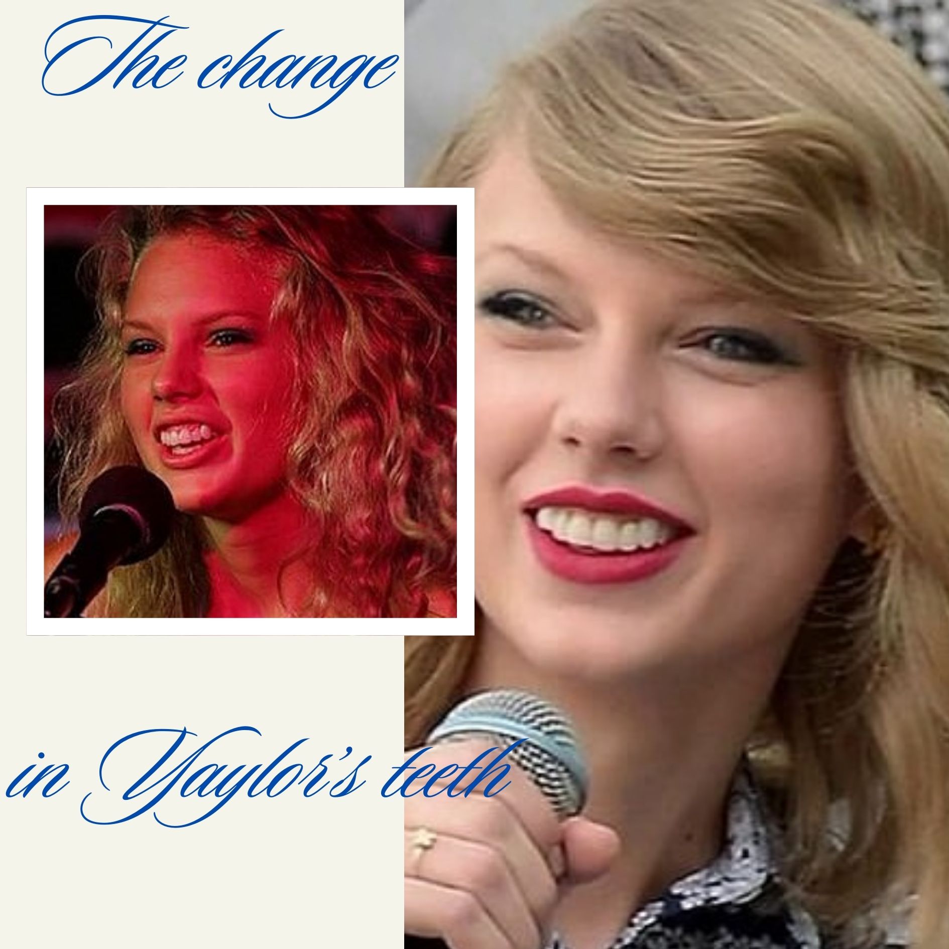 Taylor Swift Teeth Before After Turkey