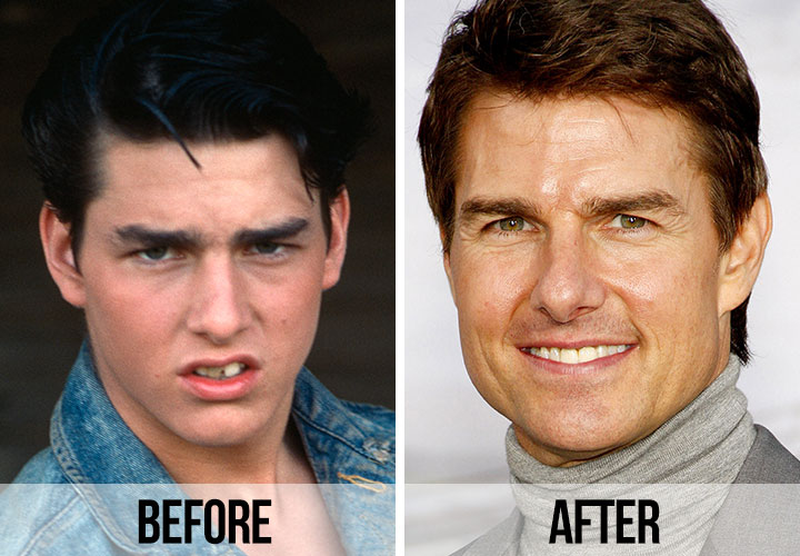 Celebrities Teeth with Veneers Before&After