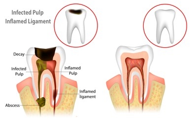 Tooth Decay Treatment-Root canal treatment Antalya