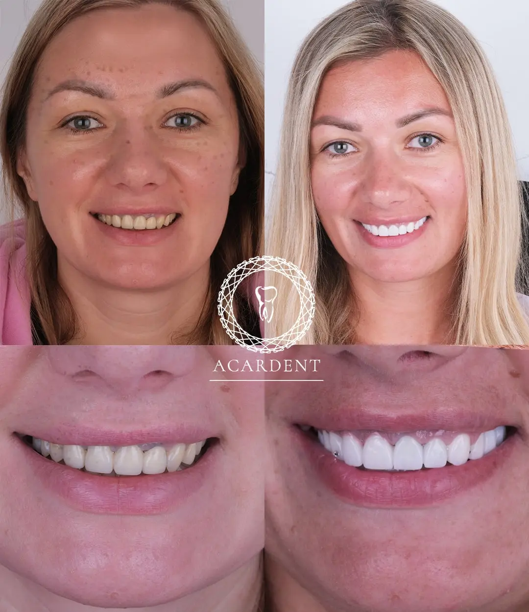 Turkey teeth before and after