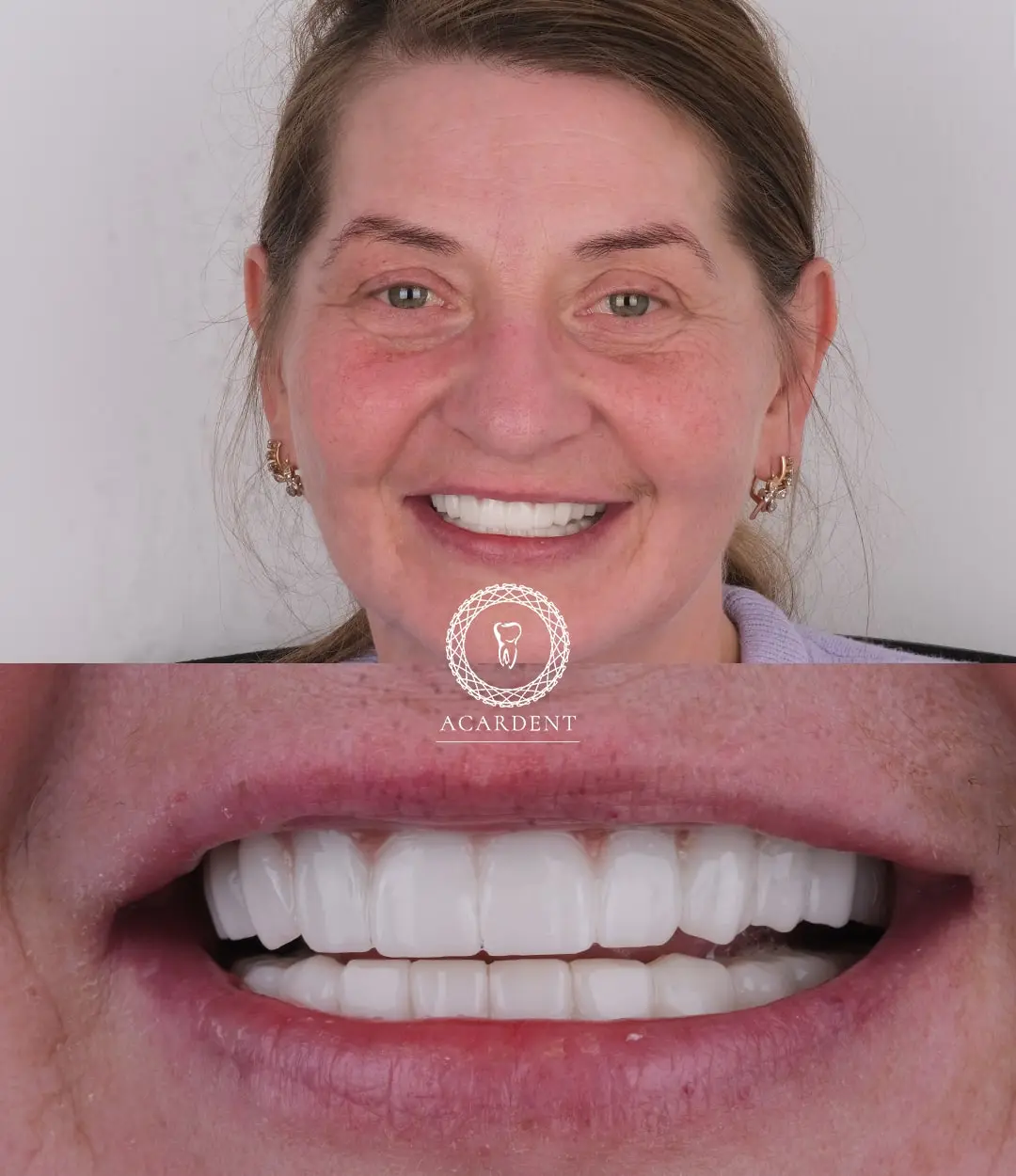 Turkey teeth before and after