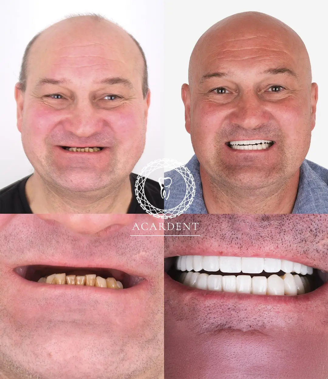 Turkey teeth before and after