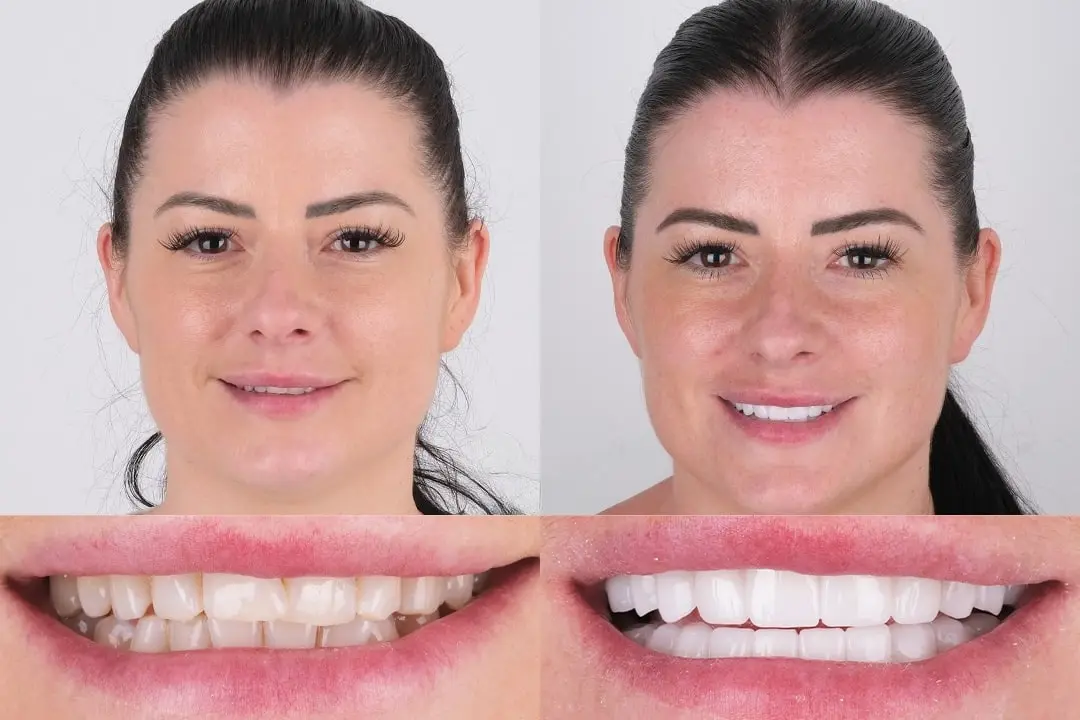 Dental crowns Dental crowns