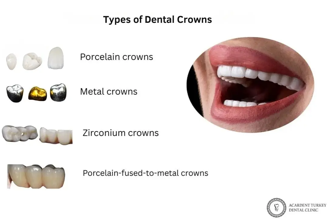 Types of dental crowns Types of dental crowns