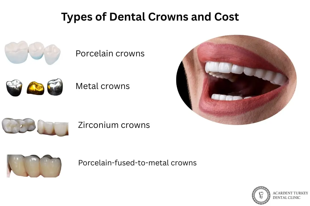 Types of dental crowns