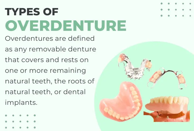Overdentures Antalya, Turkey