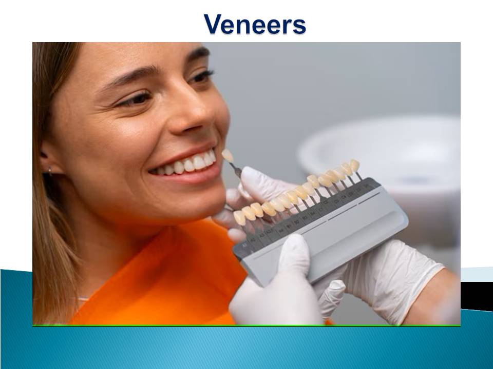 Veneers Antalya Turkey