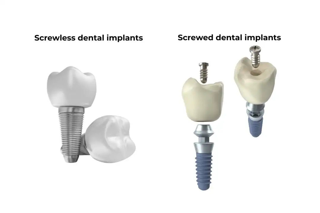 What are screwless dental implants?