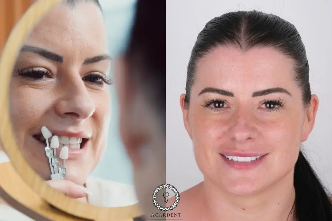 What are Turkey teeth?