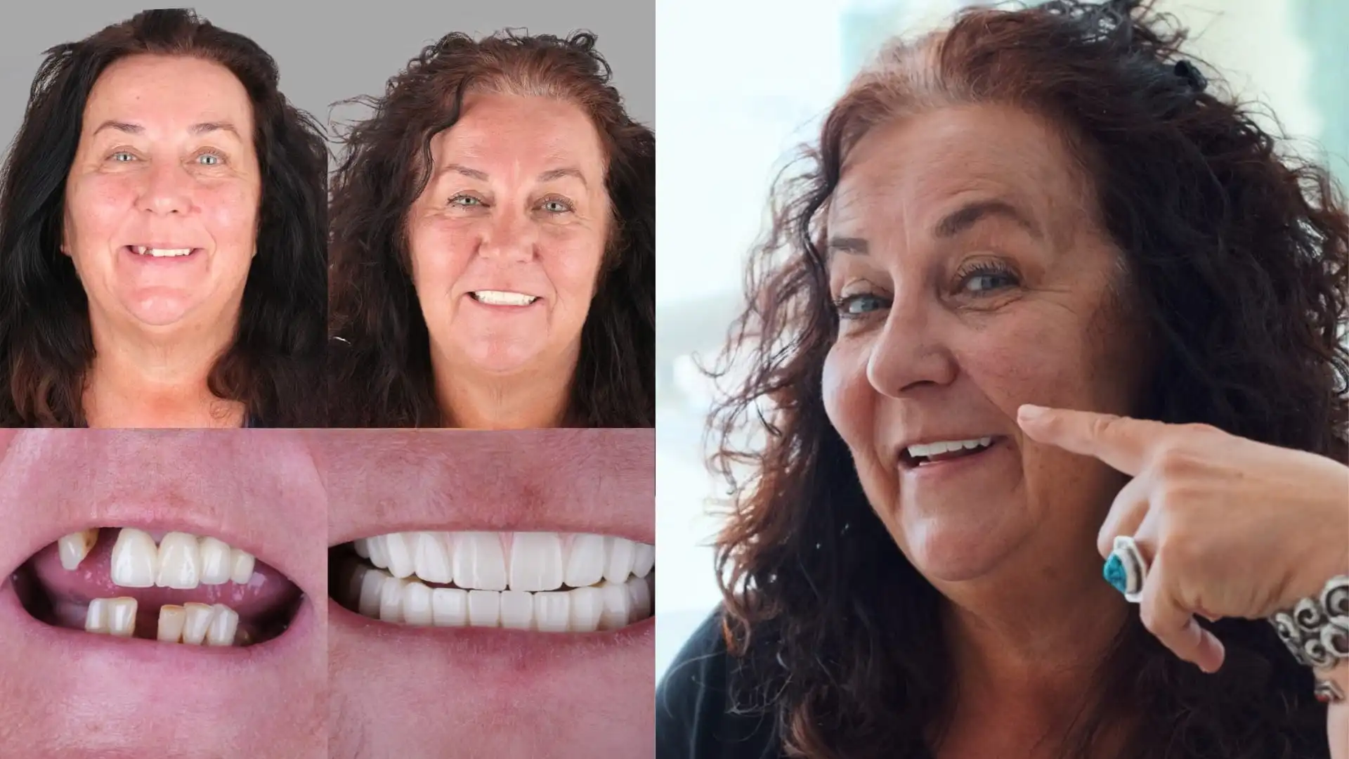 Why choose Acardent Turkey Dental Clinic for dental implants in Antalya?