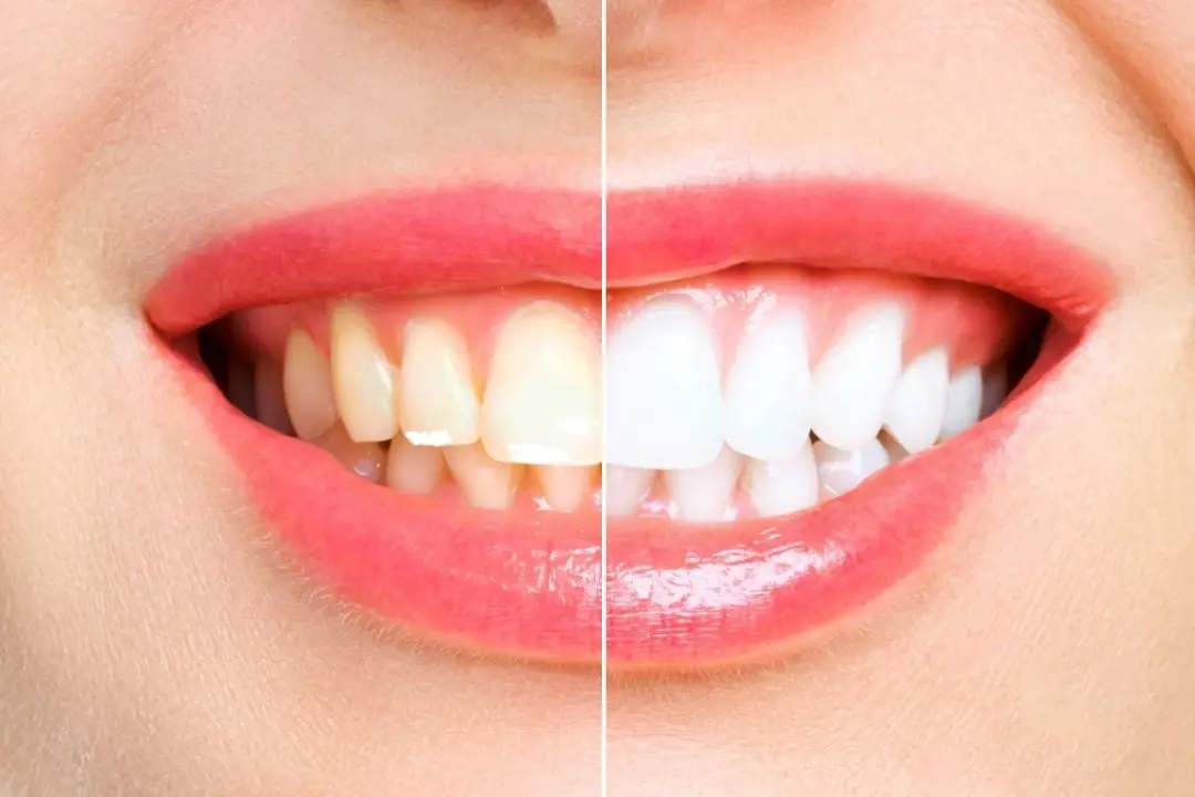 white spots on teeth white spots on teeth Antalya Turkey