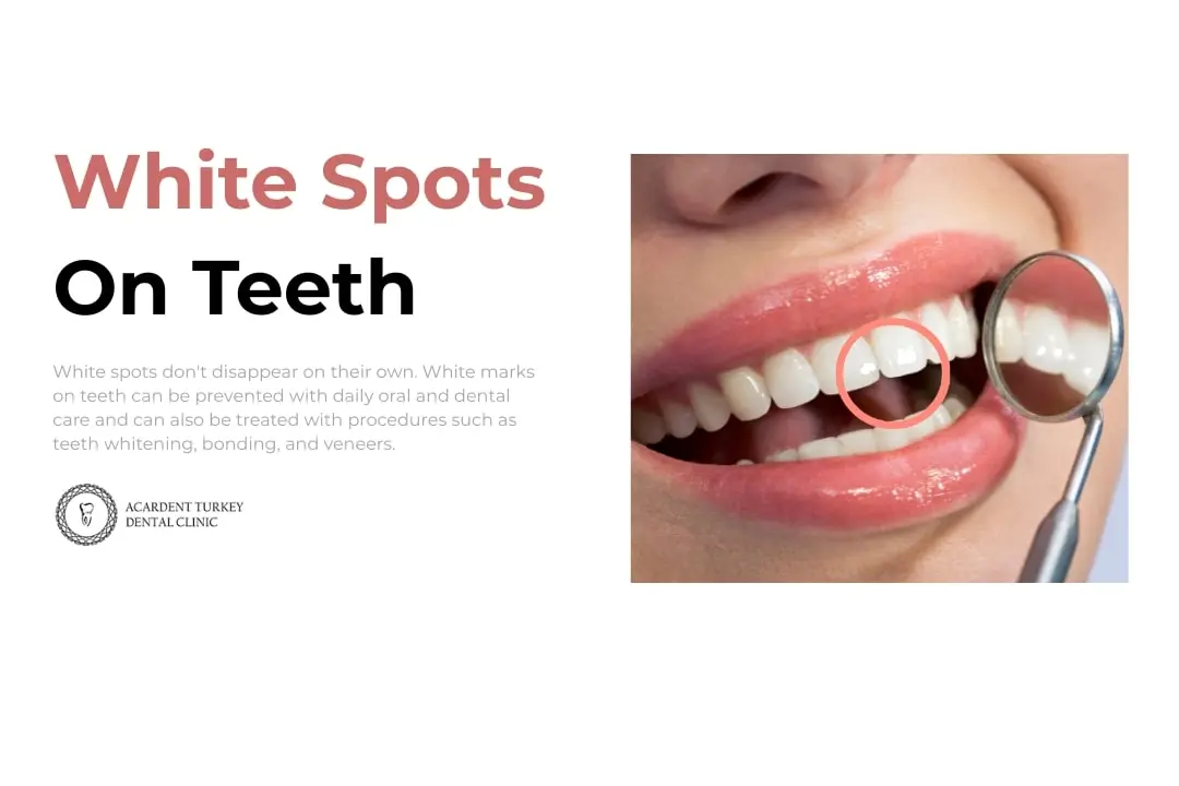 White Spots on Teeth