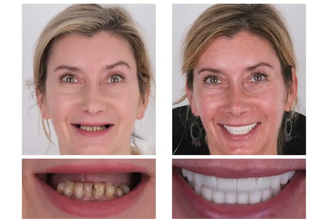 Why choose Acardent Turkey Dental Clinic for implant treatment?