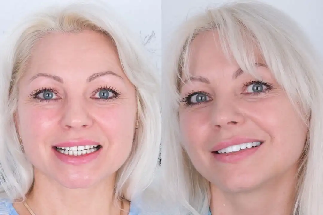 Why choose Acardent Turkey Dental Clinic for implant treatment?