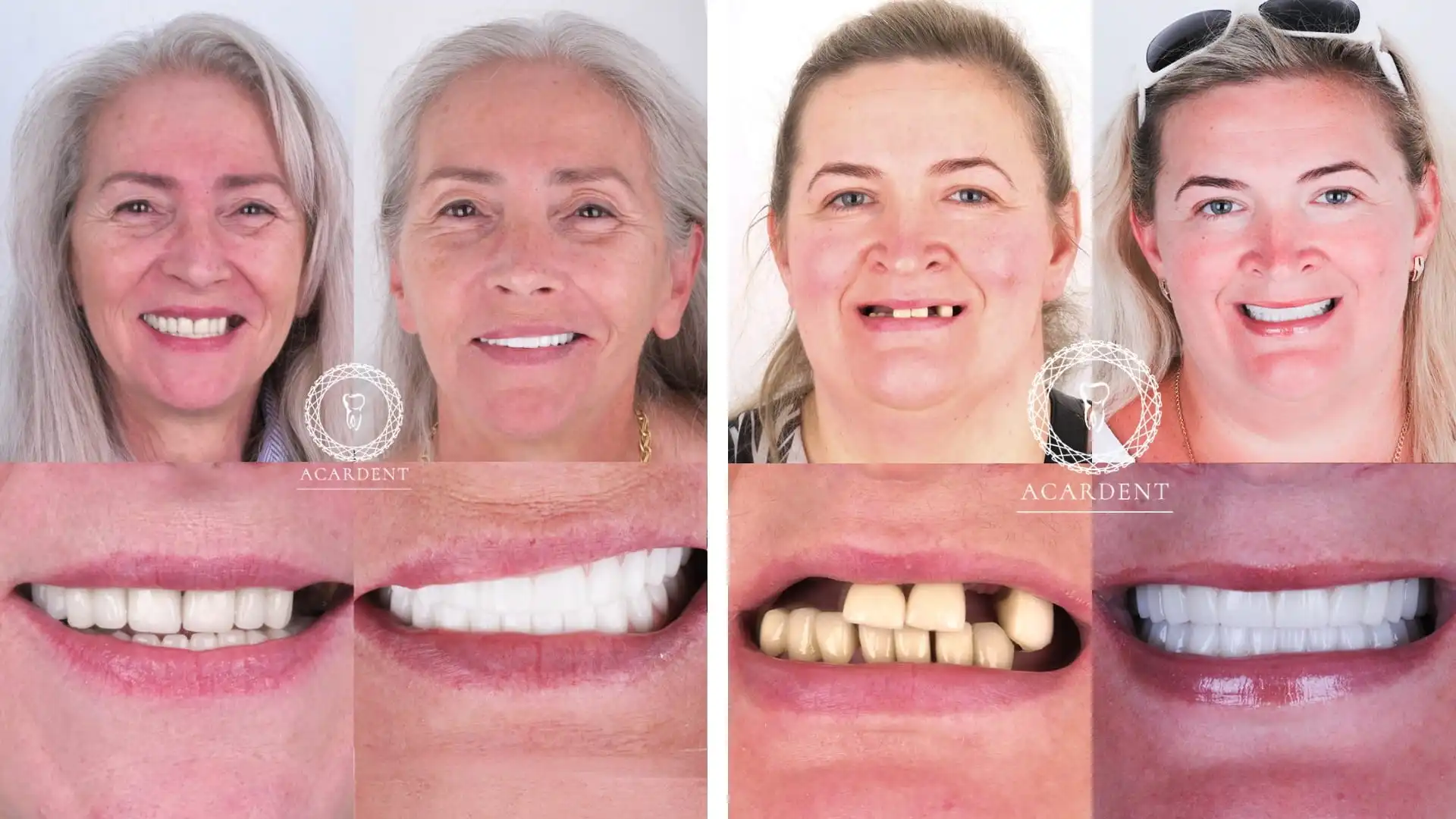 Why do patients choose Turkey for dental implants?- 1