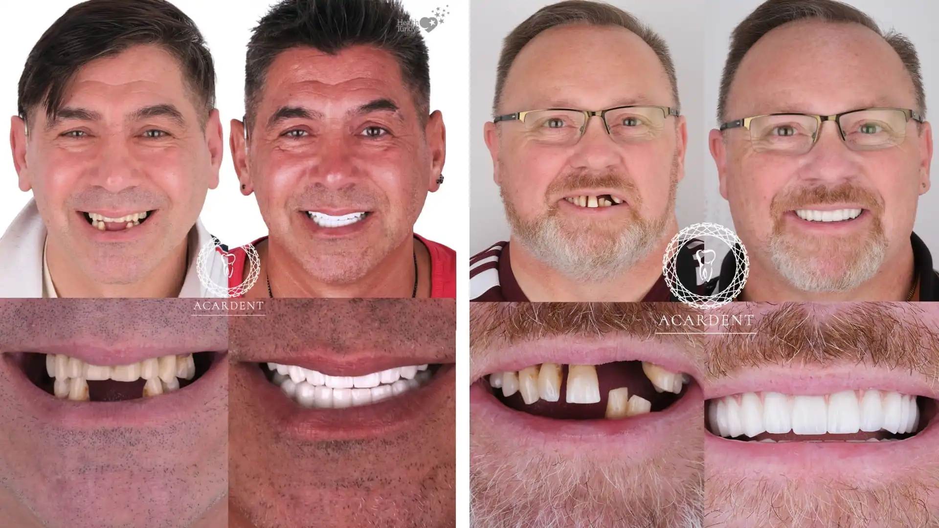 Why do patients choose Turkey for dental implants? - 2