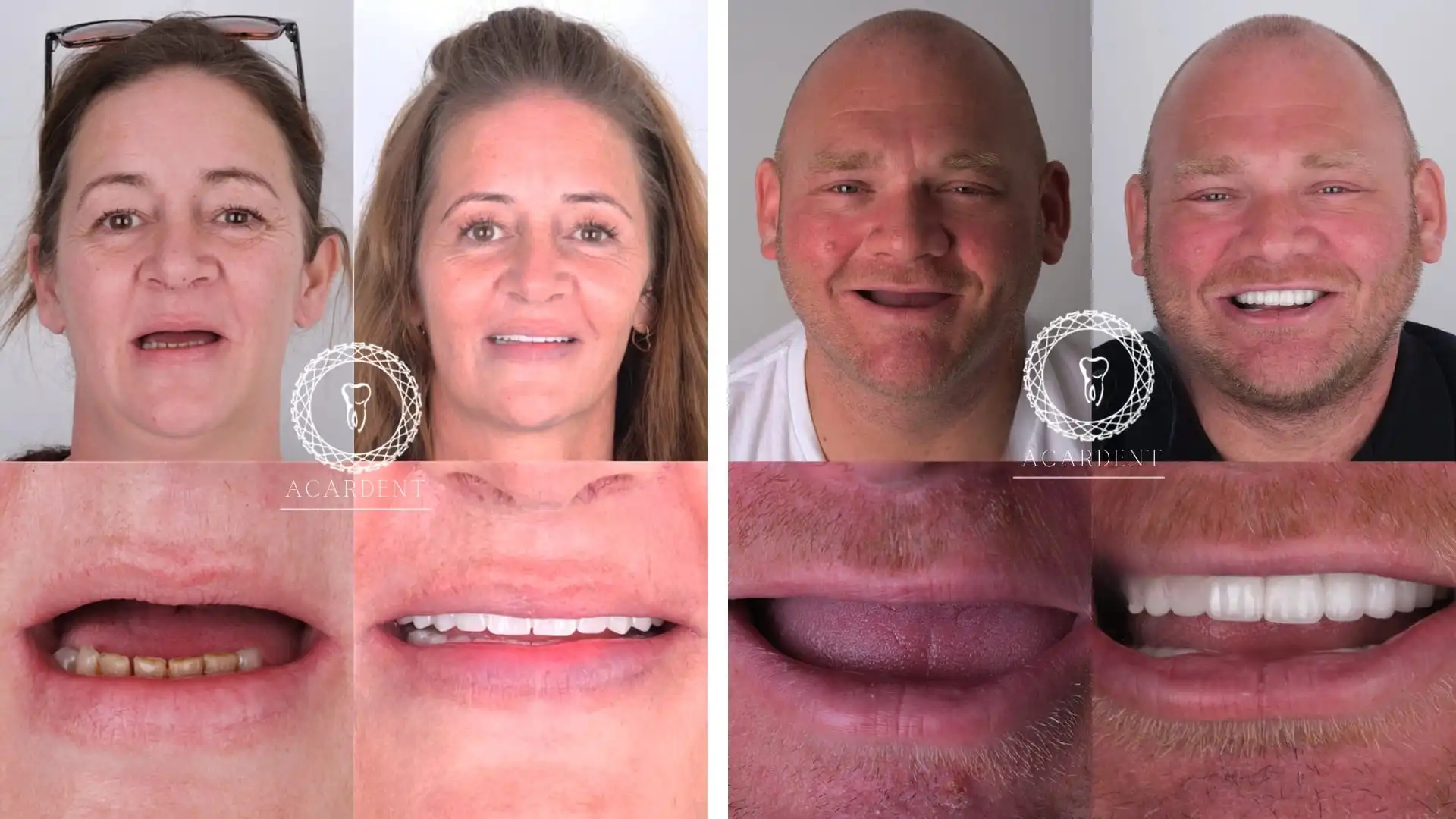 Why do patients choose Turkey for dental implants? - 3