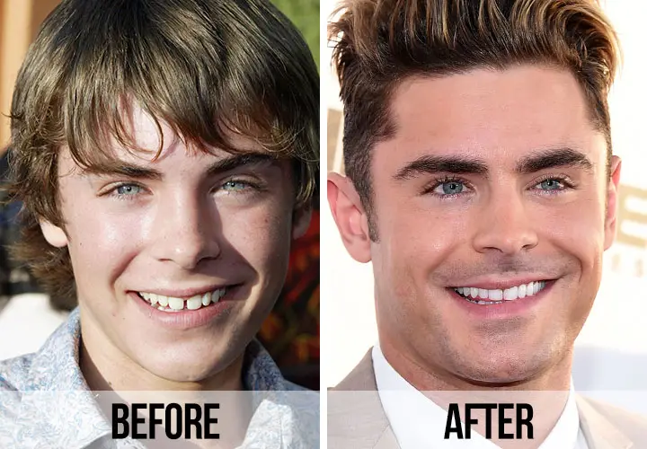 Celebrity veneers before and after Antalya, Turkey
