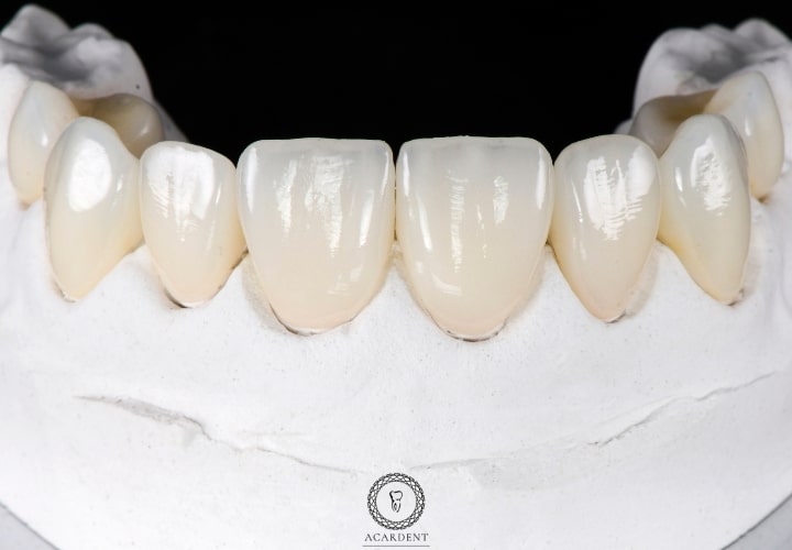 Zirconium dental veneer lifespan