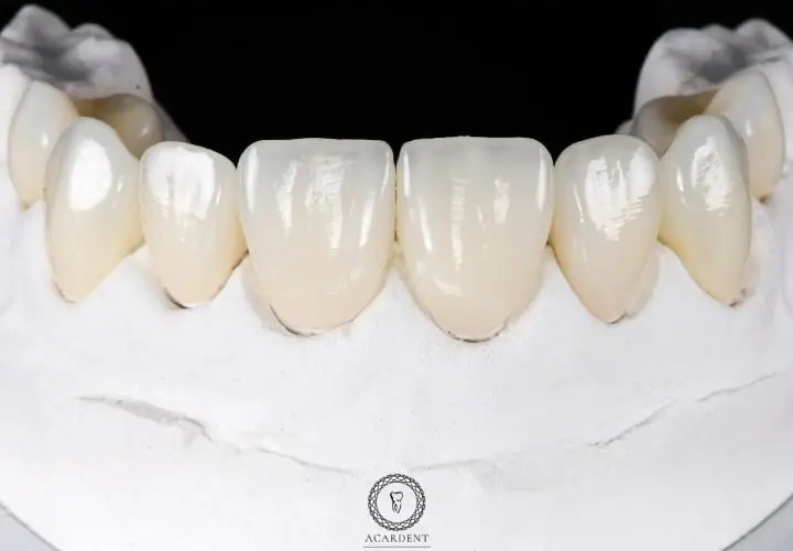 Zirconium dental veneer lifespan
