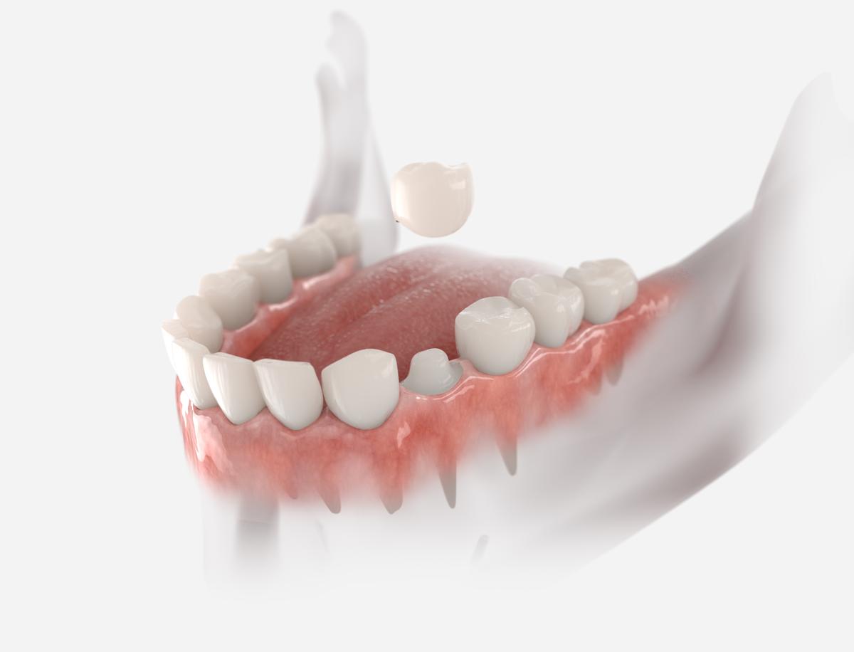 zirconium-crown-antalya-turkey-zirconia-01