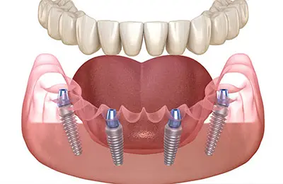 All on 4 Dental Implants