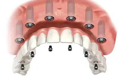 All on 6 Dental Implants