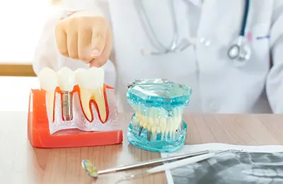 Dental Implant Turkey